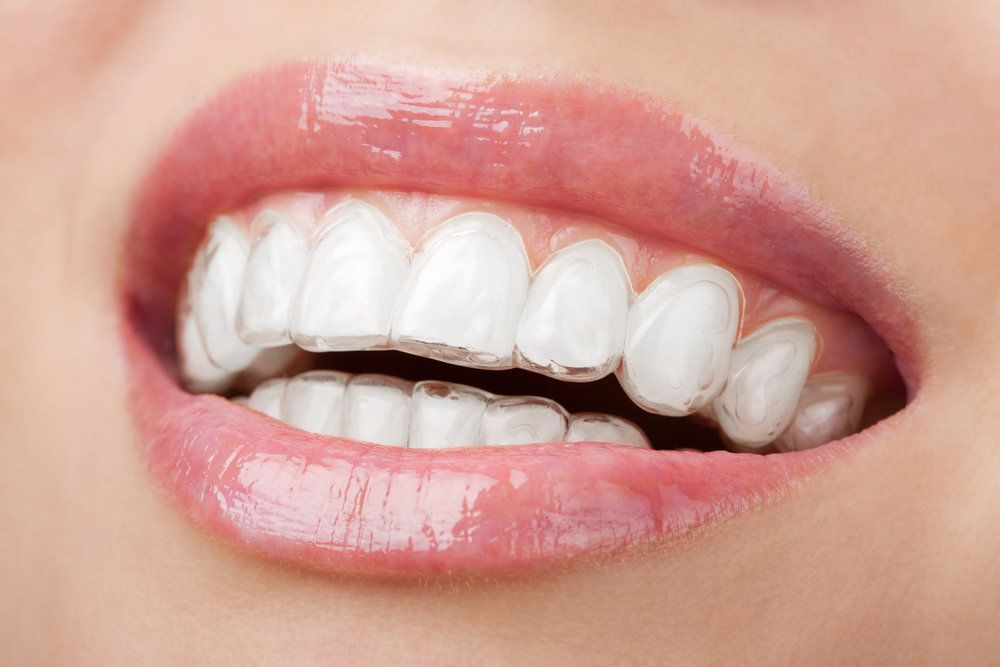 Close-up of clear Invisalign aligners being worn over the upper and lower teeth